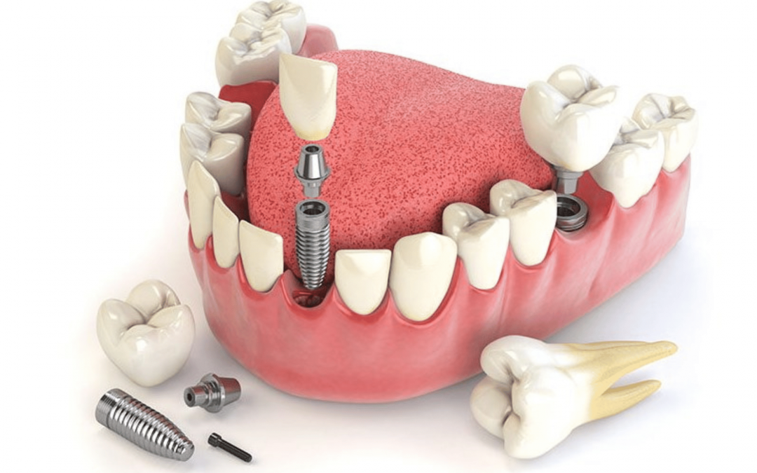 3 Principaux Avantages Des Implants Dentaires