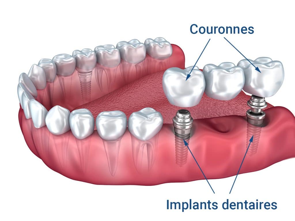 implants-dentaire-duree-de-vie
